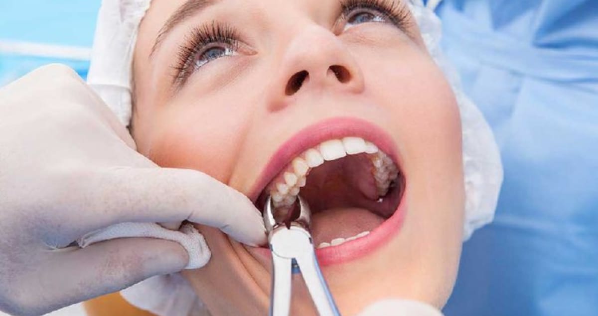 When Can I Vape After Wisdom Teeth Removal? Tips and Tricks