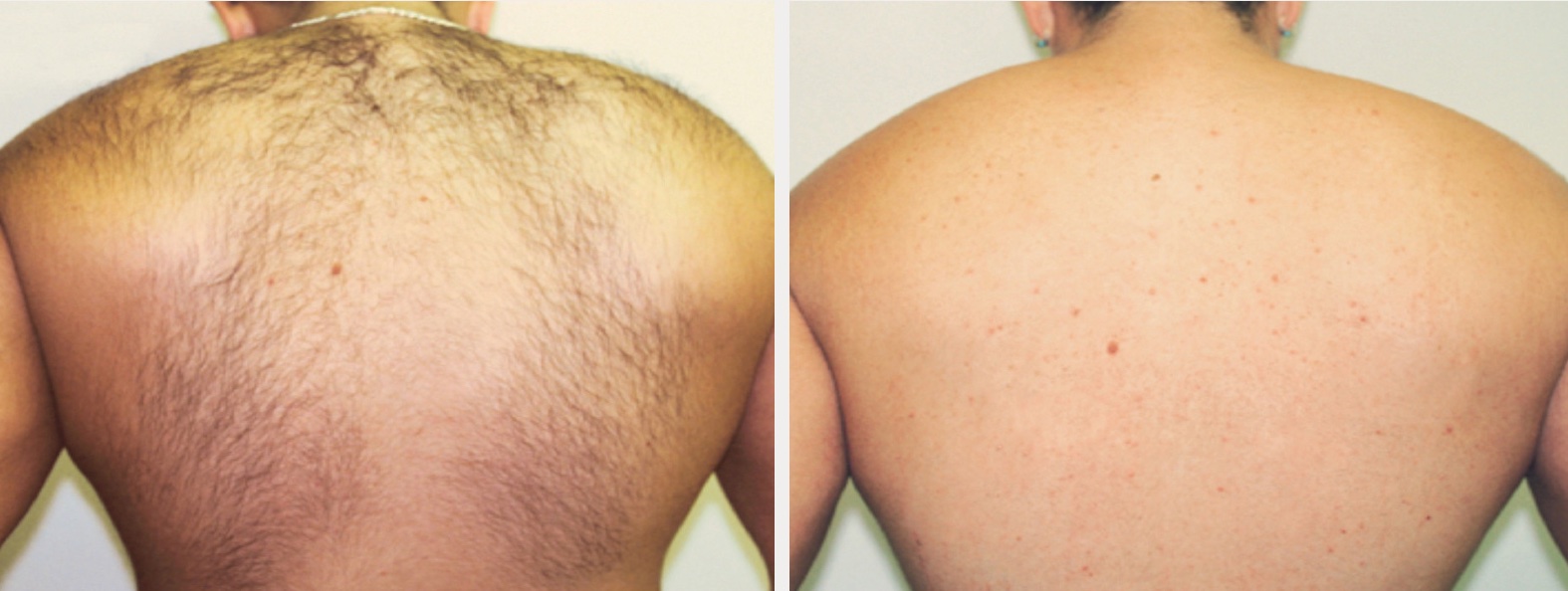 Laser Hair Removal in Naperville