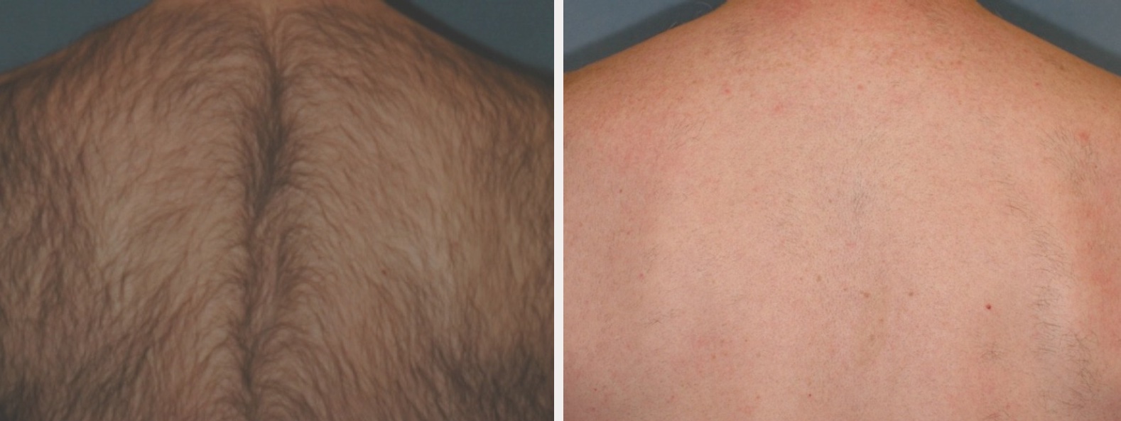 Laser Hair Removal in Naperville