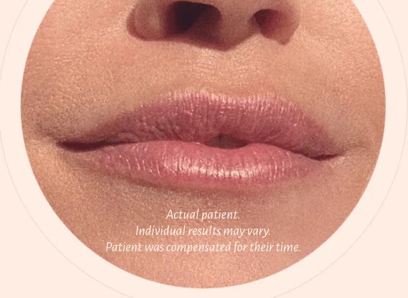 Restylane Kysse Lip Filler in NYC Smooth Synergy Medical Spa & Laser