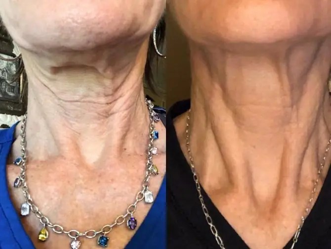 RF Microneedling Neck and Chest Smooth Synergy Medical Spa & Laser Center