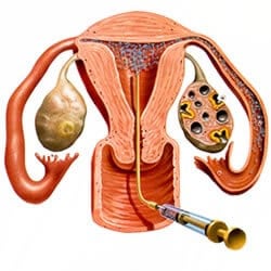 Is Kunstmatige Inseminatie Echt Nodig? (+ Alternatieven)