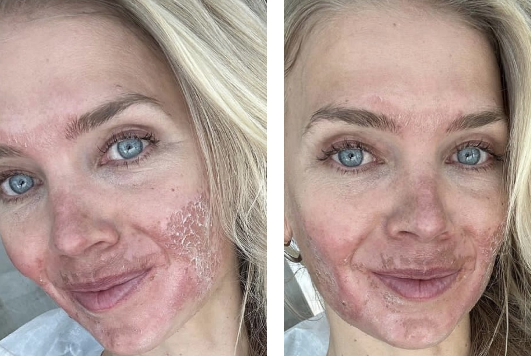 The Effects of High Altitude on Your Body’s Largest Organ The Skin SnowBrains