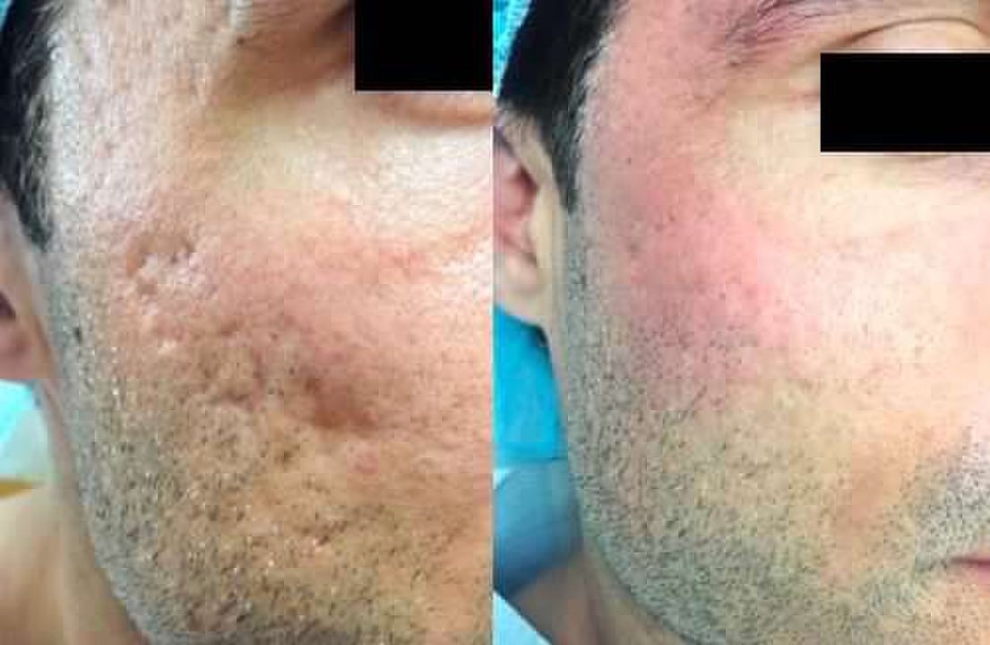 Silicone Acne Sobel Skin