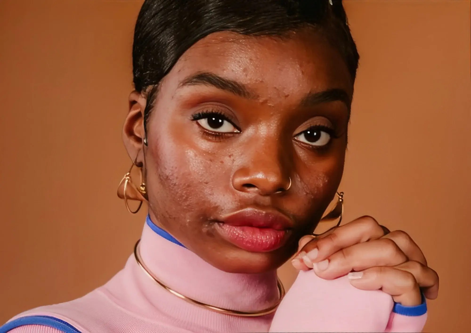 How To Get Rid Of Acne Scars On Face Your Clear Skin Guide SoboTips