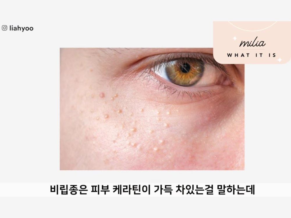 Perbedaan Whitehead, Milia, dan Fungal Acne serta Cara Mengatasinya