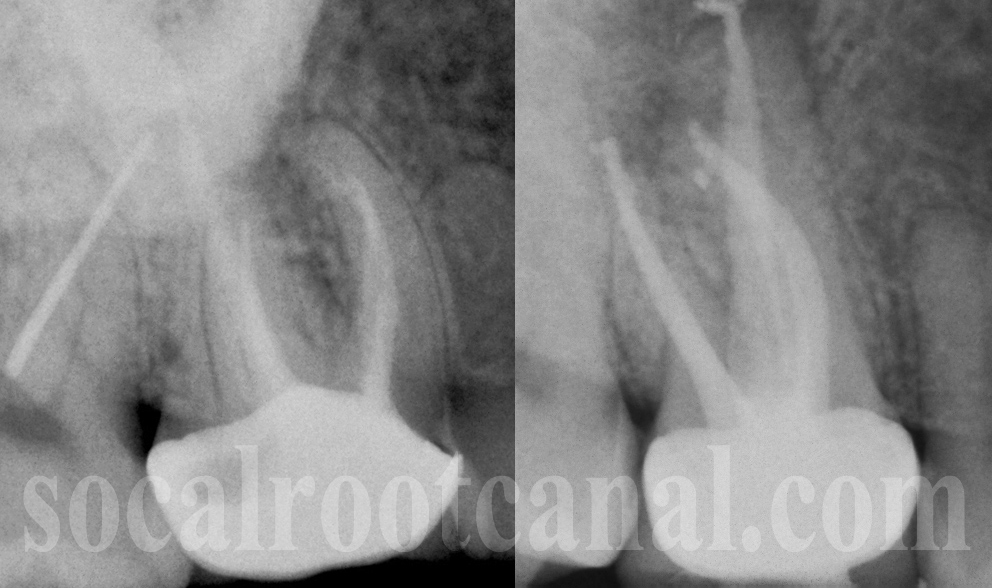 Tightly Curved Calcific Canals. SoCal Root Canal