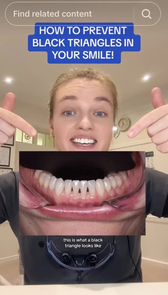 Dentist Shares What It Actually Means If You Have ‘Black Triangles