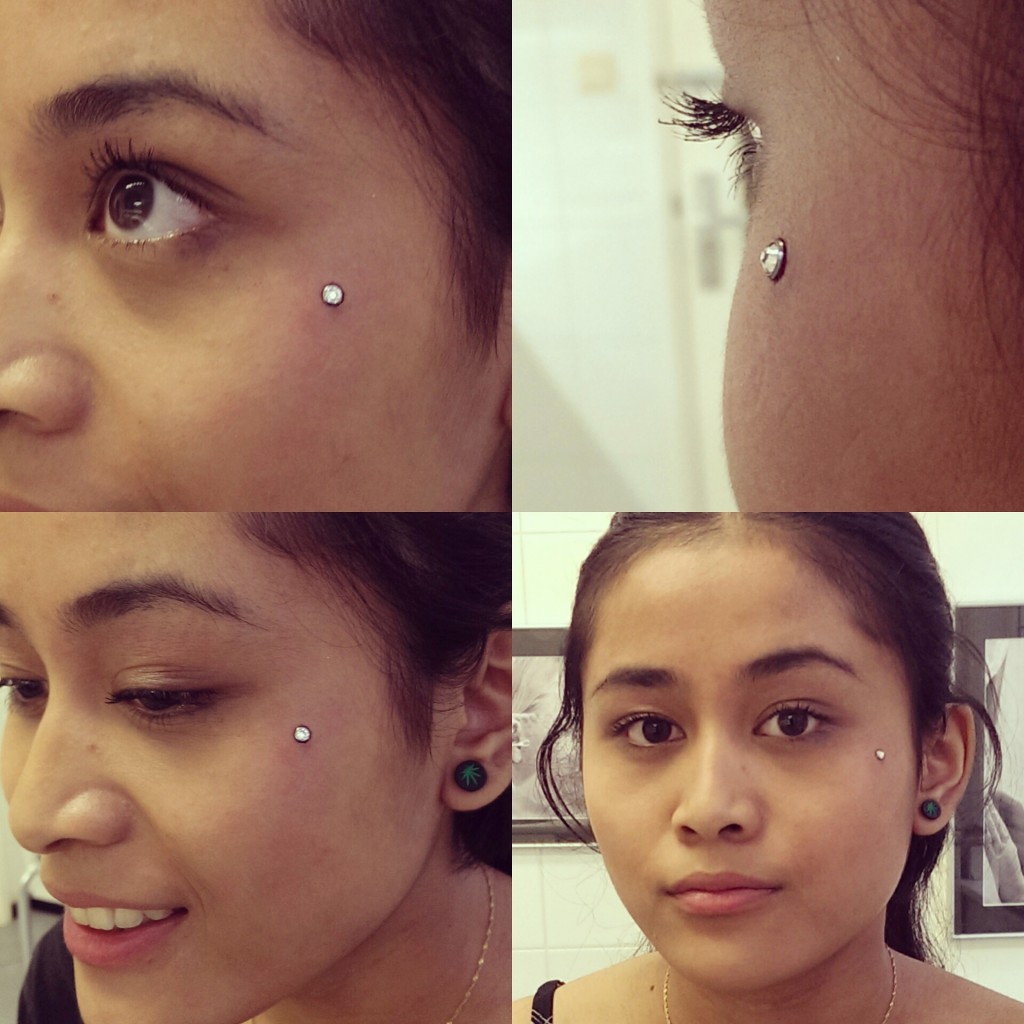 Surface anchor or microdermal or dermal anchor