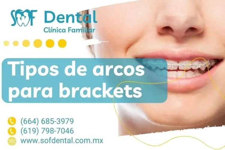 Tipos de arcos para brackets SOFDental Dentistas en Tijuana