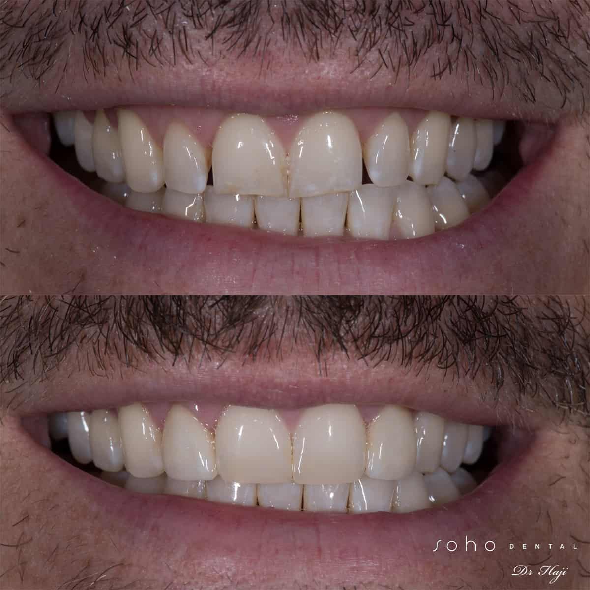 Bonding and Porcelain Veneers Downtown Toronto Dentist Toronto