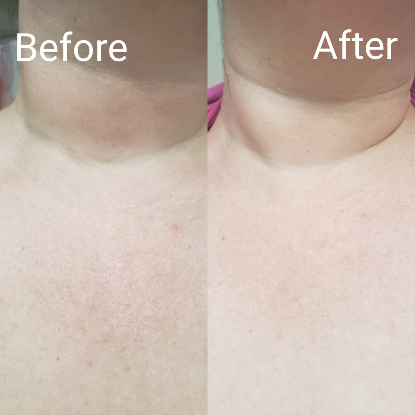 Chest / Decolletage Treatment 75 for 5 Treatments Soke Beauty