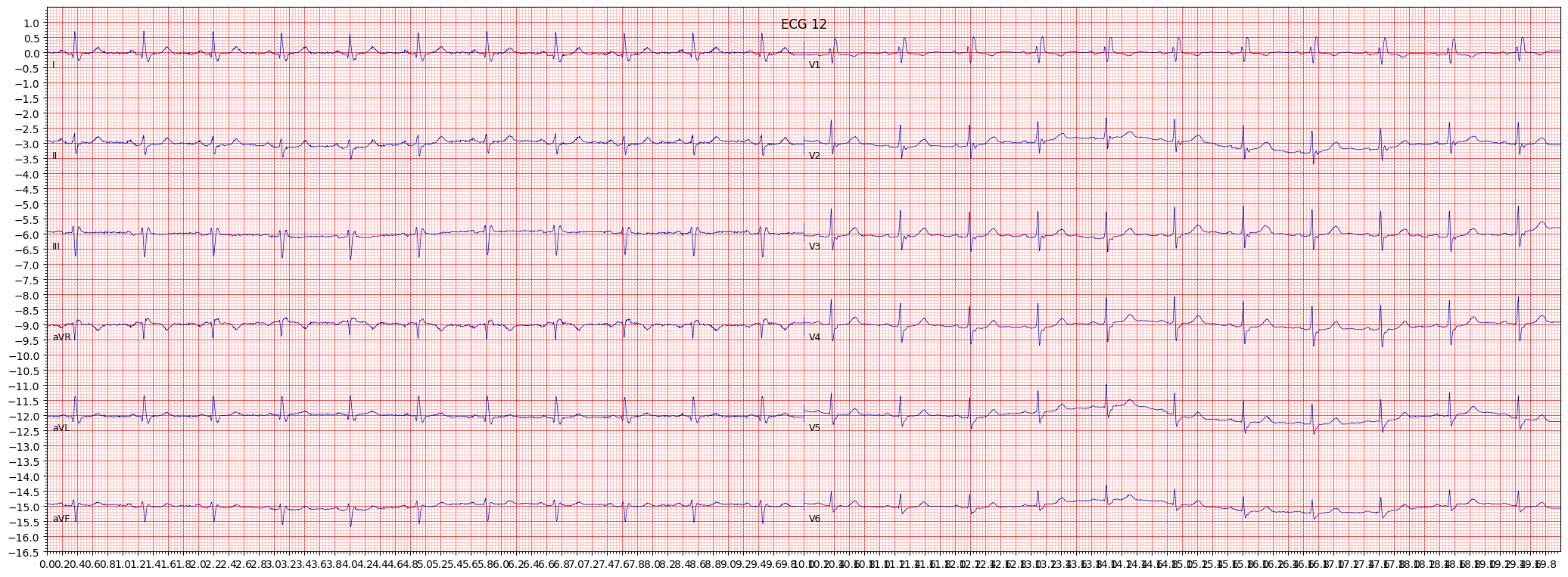 Examples of right bundle branch block (IRBBB) ECG Library