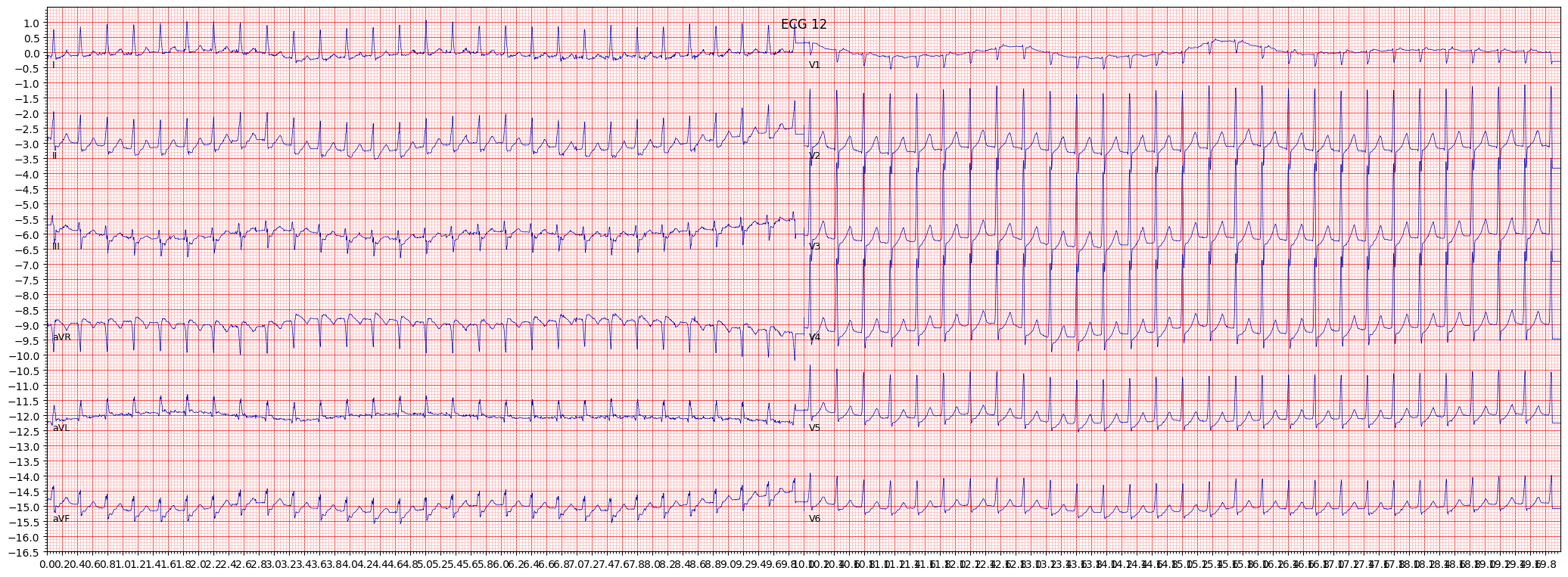 Psvt Ecg Clinical Practice Guidelines Supraventricular Tachycardia
