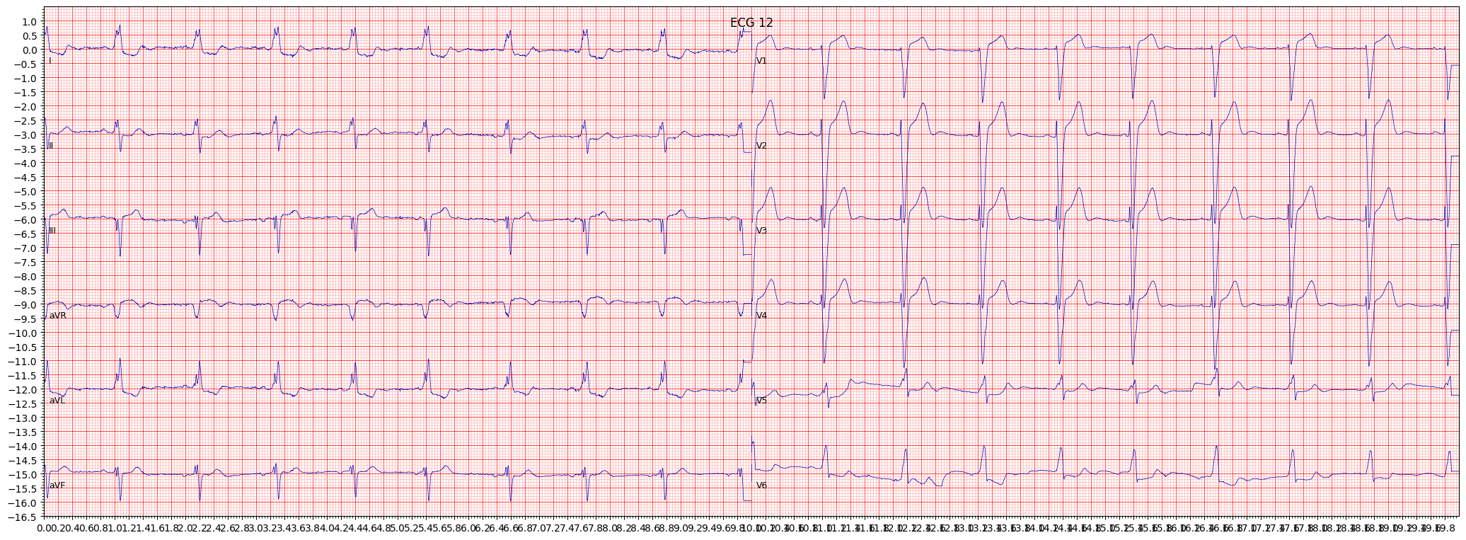Examples of complete left bundle branch block (CLBBB) | ECG Library