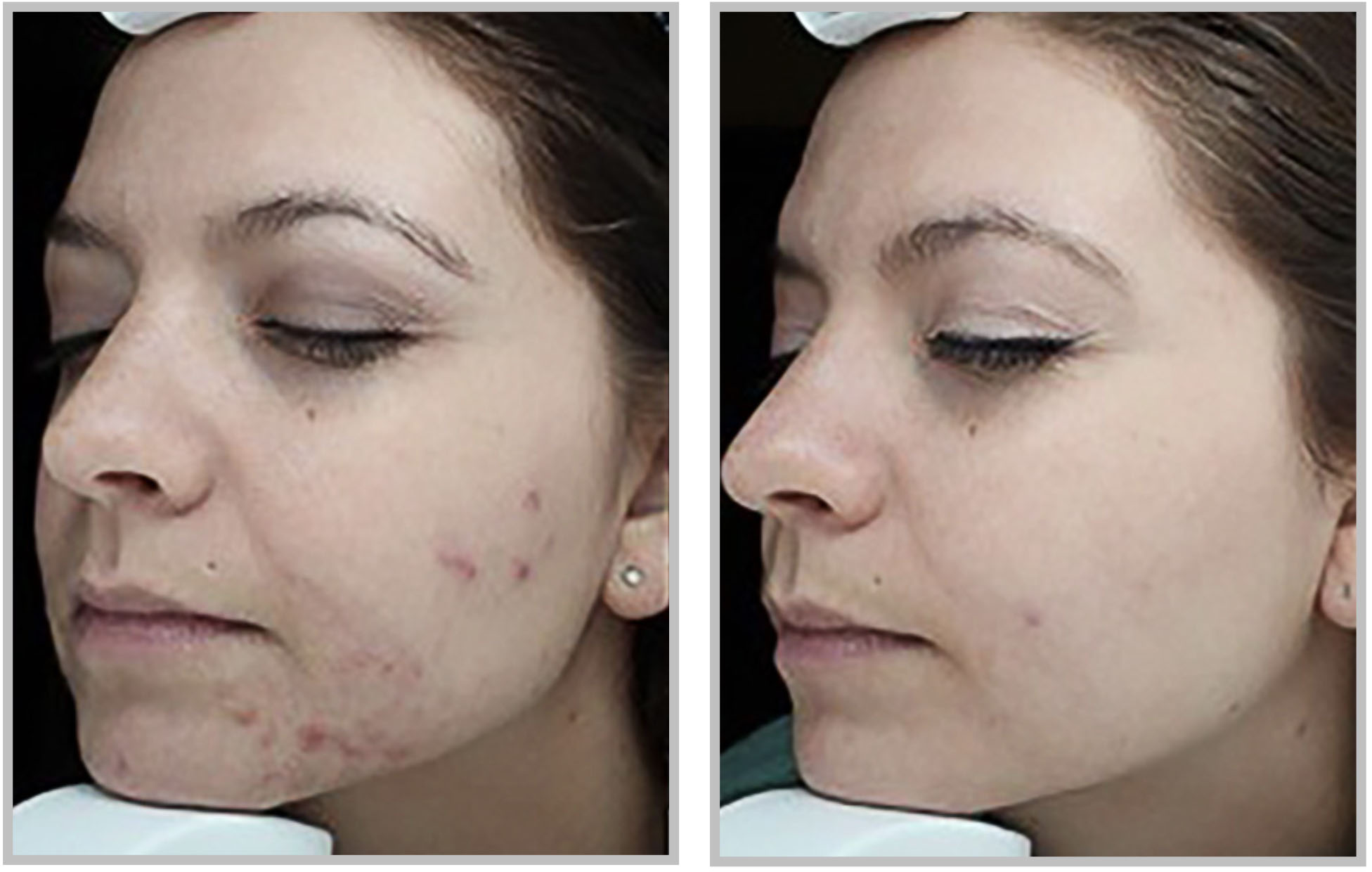 Forever Clear Acne Treatment in Chicago at Solve Clinics