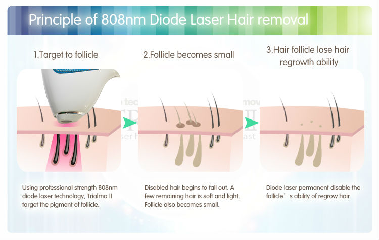 Laser Hair Removal info Somalaser