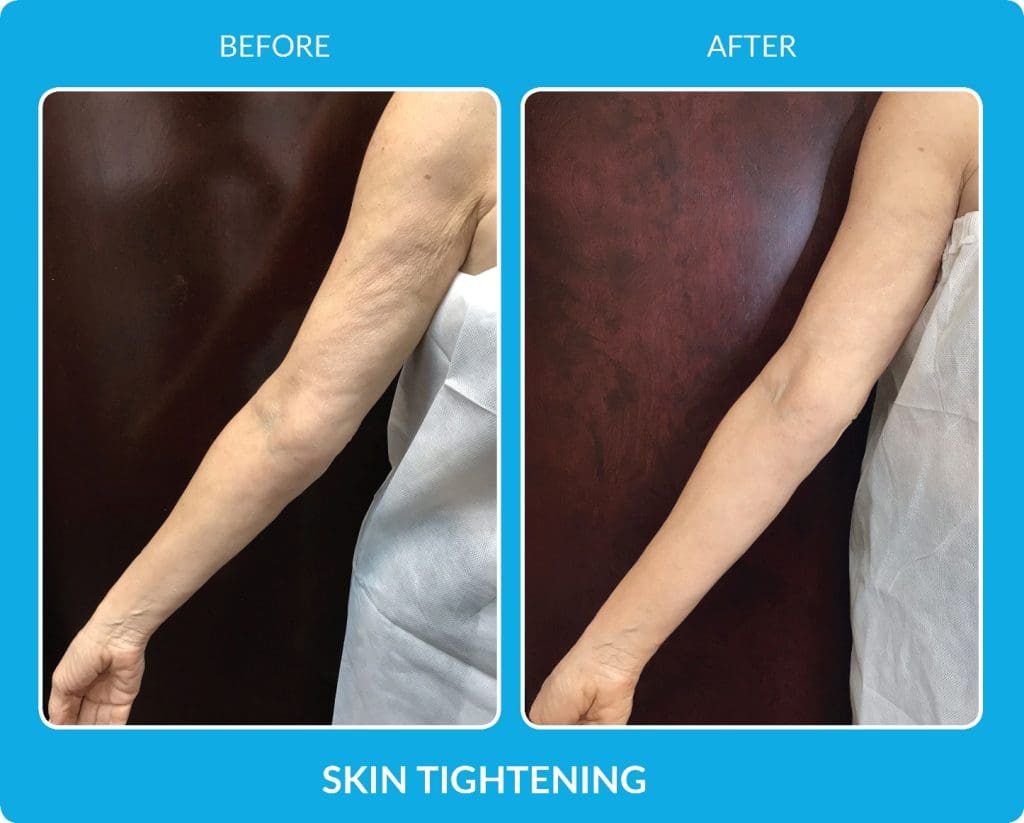 ProCell on arms Before and After Somalaser