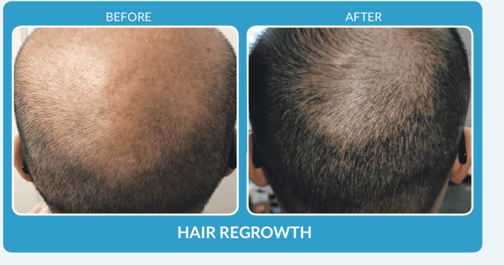 Hair Regrwoth with ProCell Before & After Somalaser