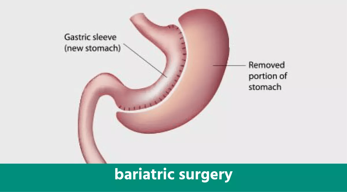 Weight Loss Surgery Near Me