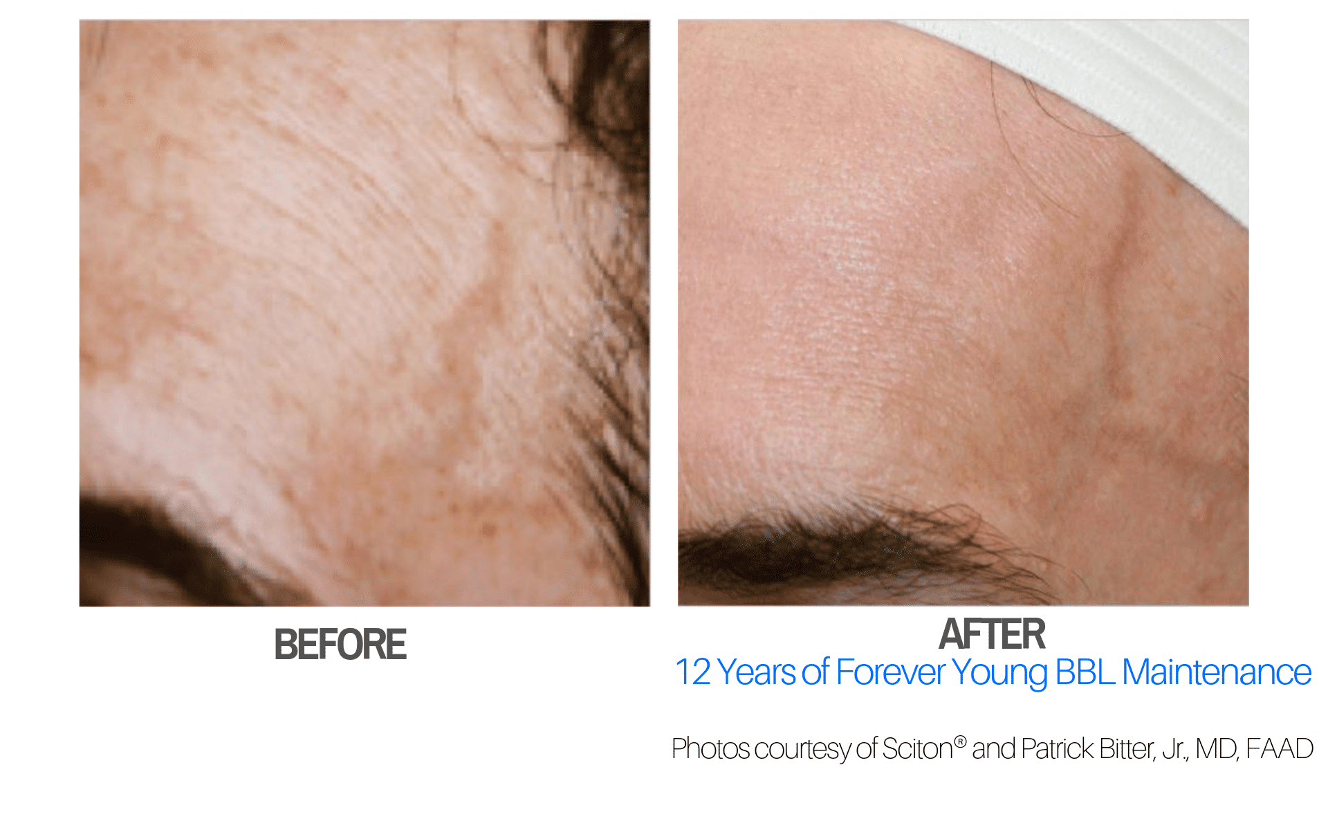 BBL Skin Rejuvenation SONA MD