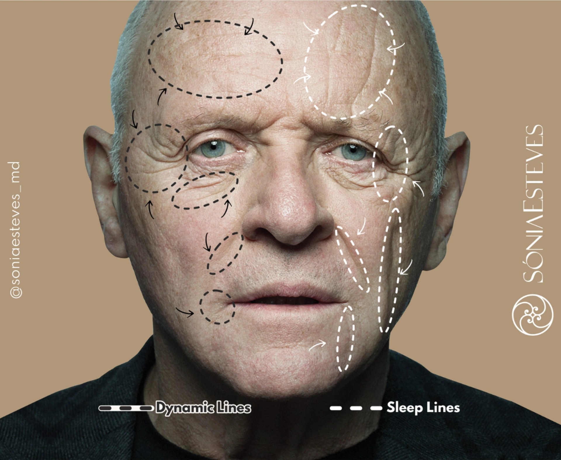 Sleep lines o que são, como prevenir e tratar • Sónia Esteves