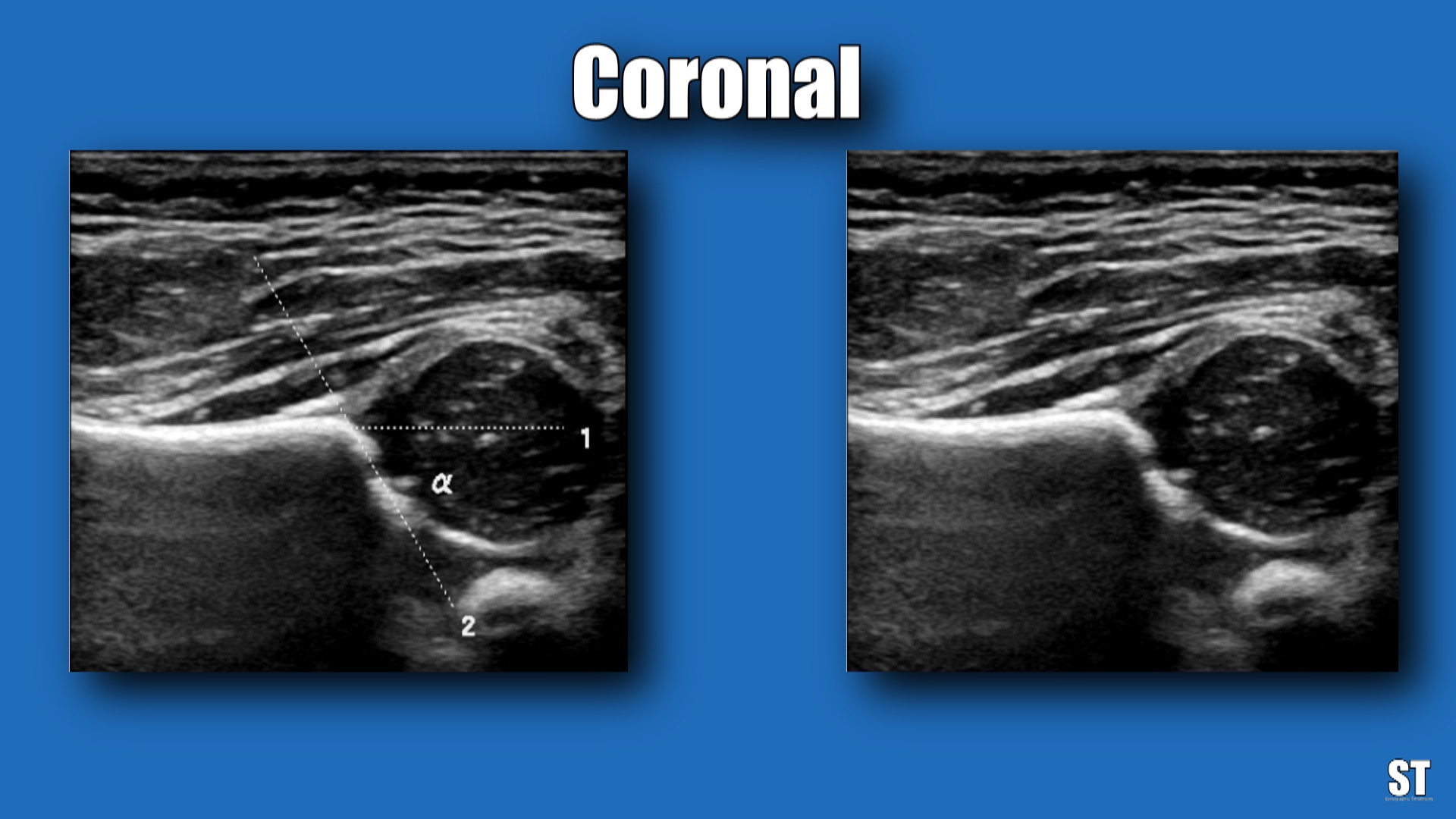 Neonatal Hip Ultrasound Sonographic Tendencies