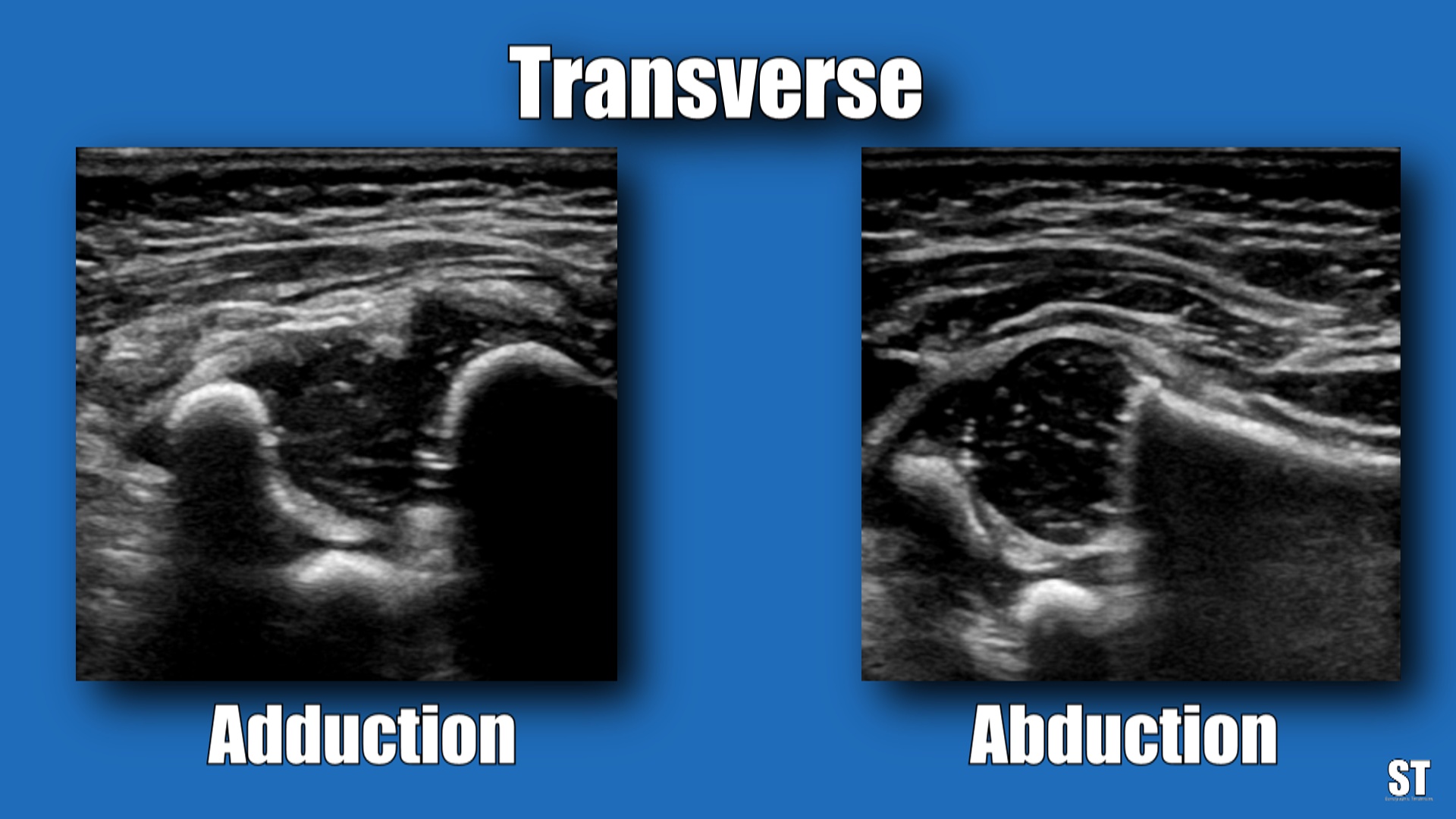 Neonatal Hip Ultrasound Sonographic Tendencies