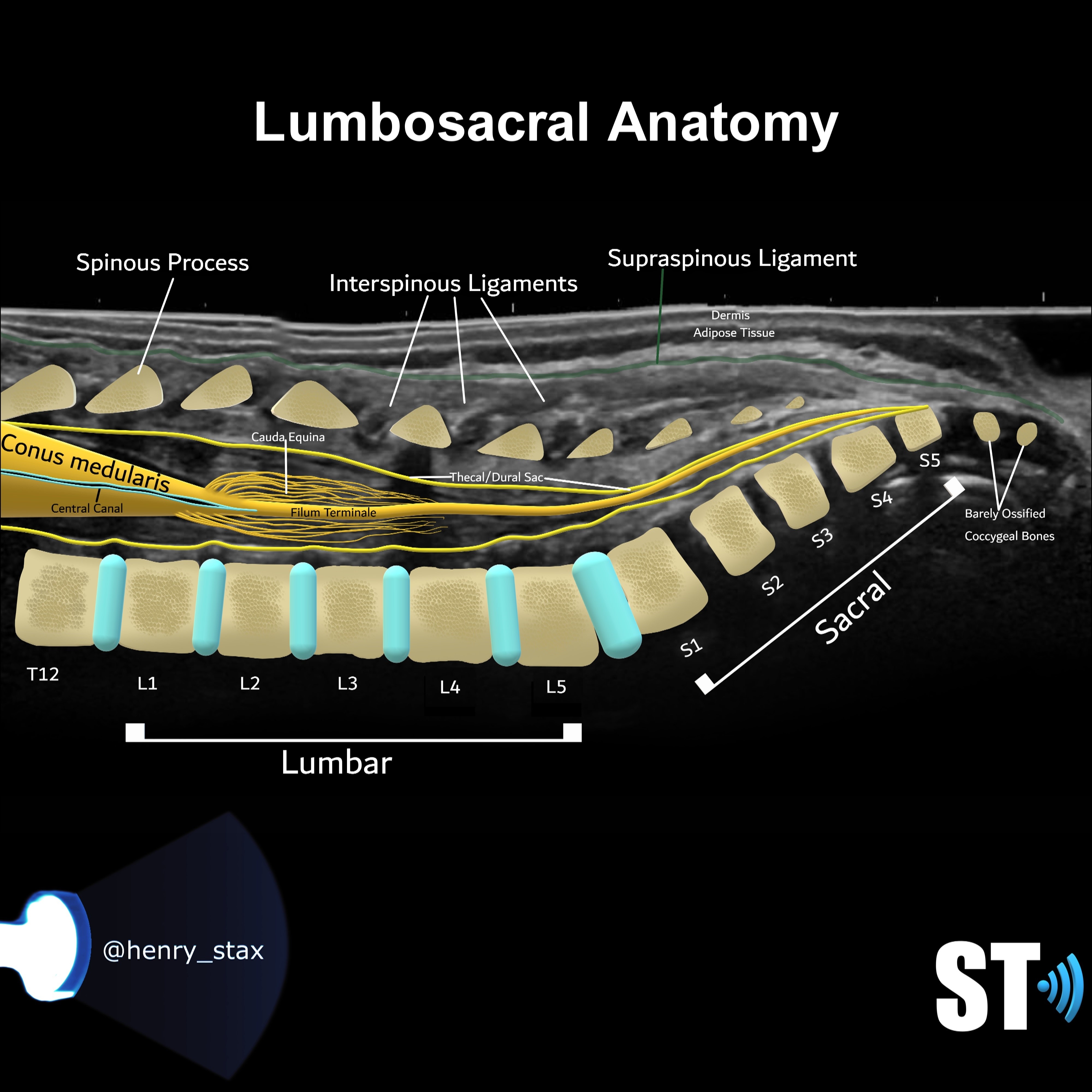 Neonatal/Infant Spine Sonographic Tendencies