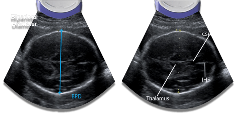 Distance Measurement By Ultrasound Circuiteasy