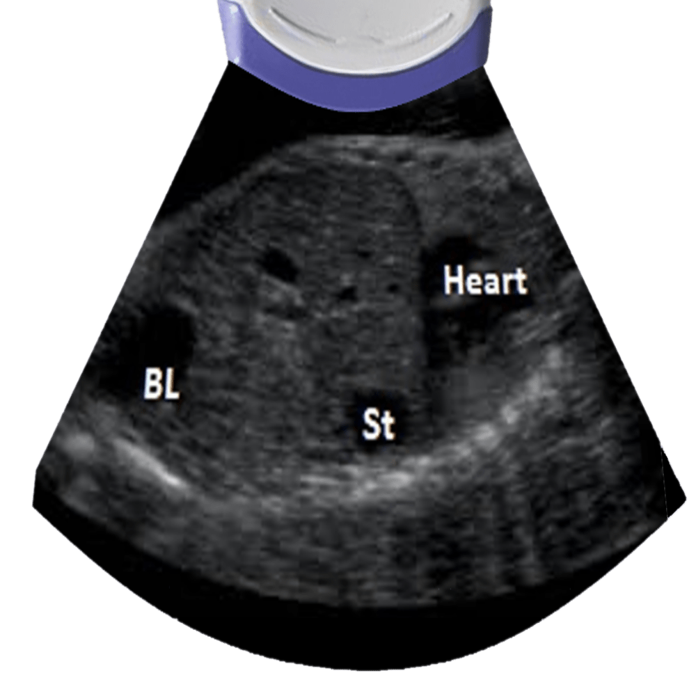 OB Ultrasound Second Trimester (The Basics) Sonographic Tendencies