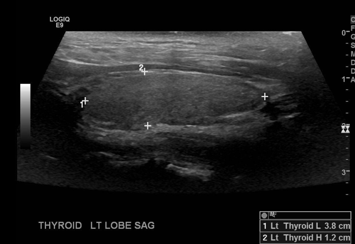 Thyroid Ultrasound Protocol Sonographic Tendencies