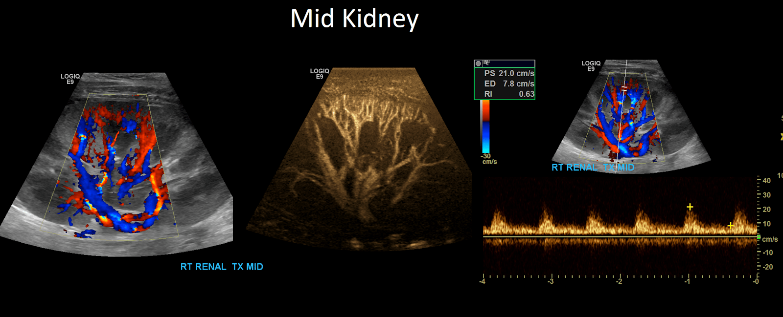 Renal Transplant Duplex Protocol Sonographic Tendencies