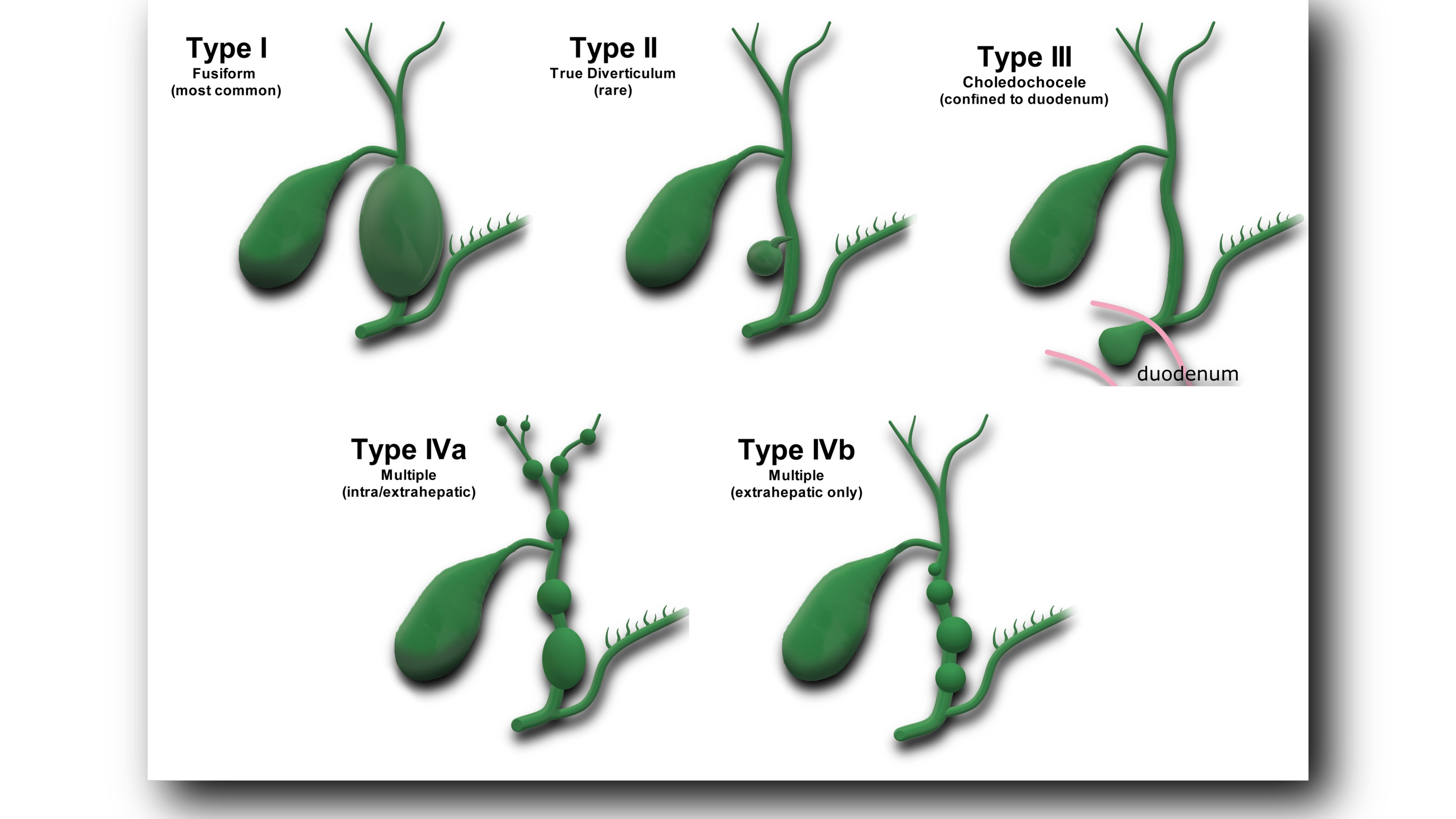 Choledochal Cyst Sonographic Tendencies