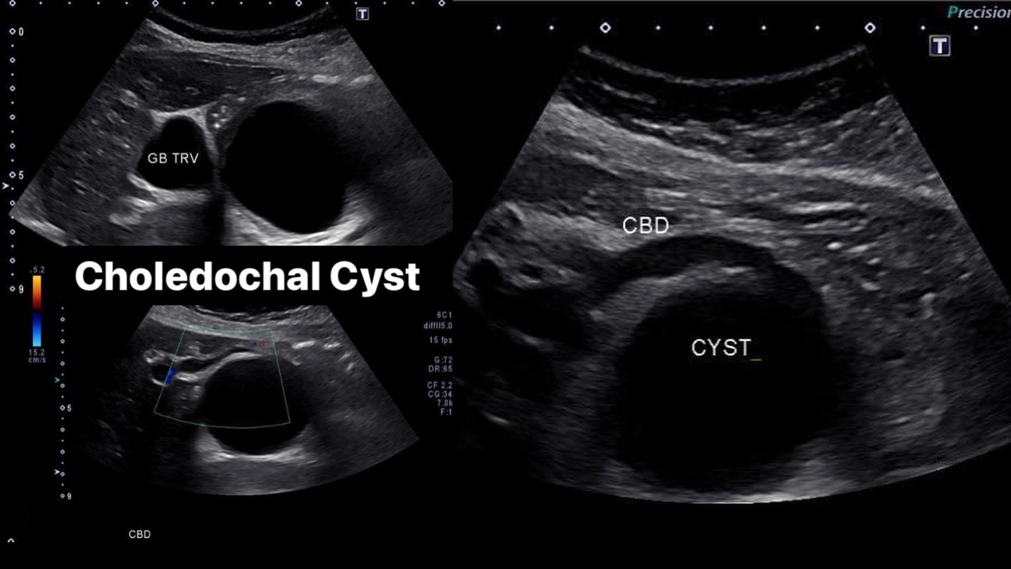 Choledochal Cyst Sonographic Tendencies