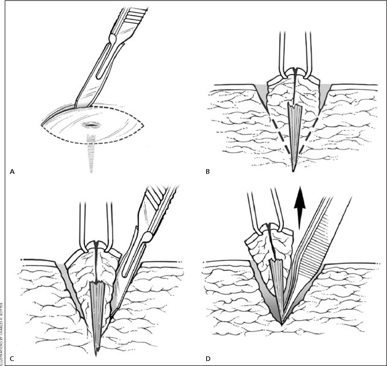 Ultrasoundguided detection of foreign bodies in softtissue SONOSIF