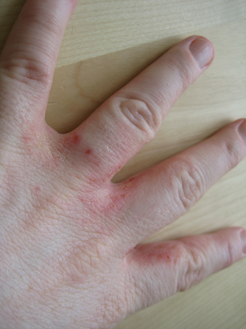 Small White Itchy Bumps On Hands