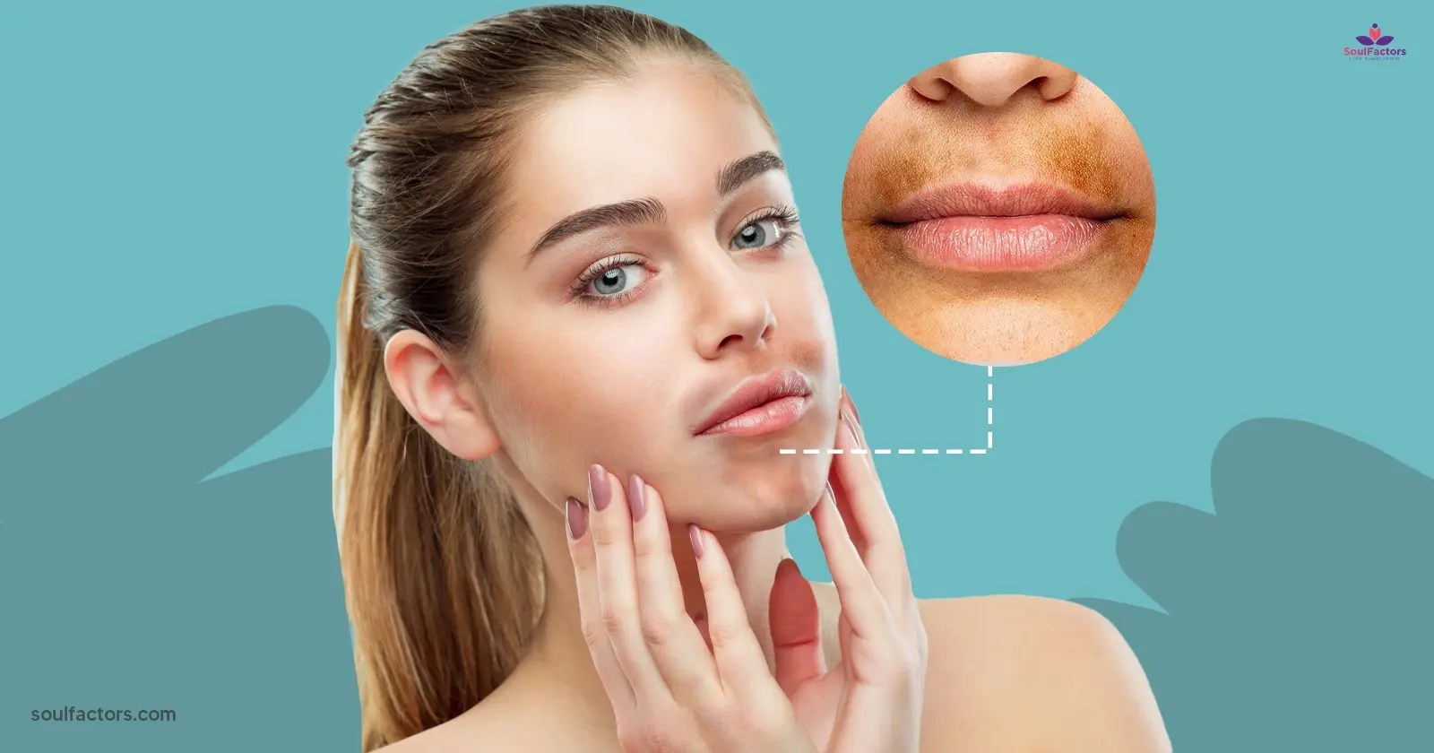 Hyperpigmentation Around The Mouth Causes & Treatment!