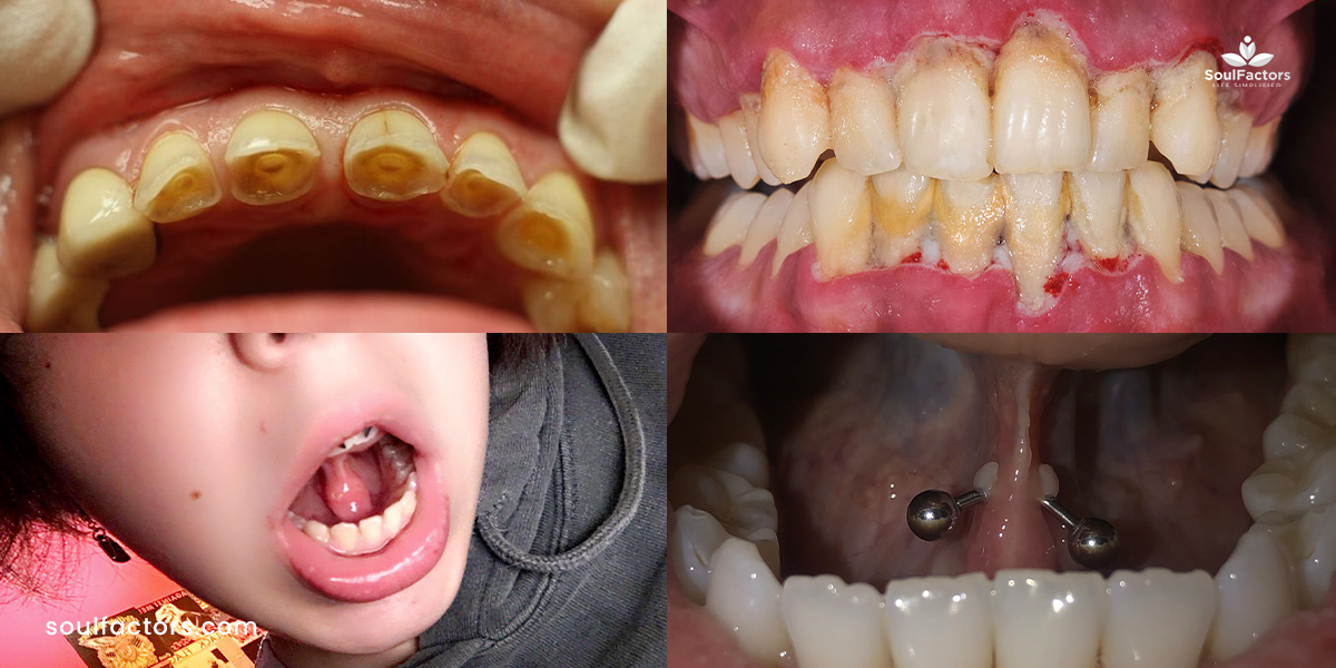 Frenulum Piercing Procedure, Aftercare & Unique Style Statement!