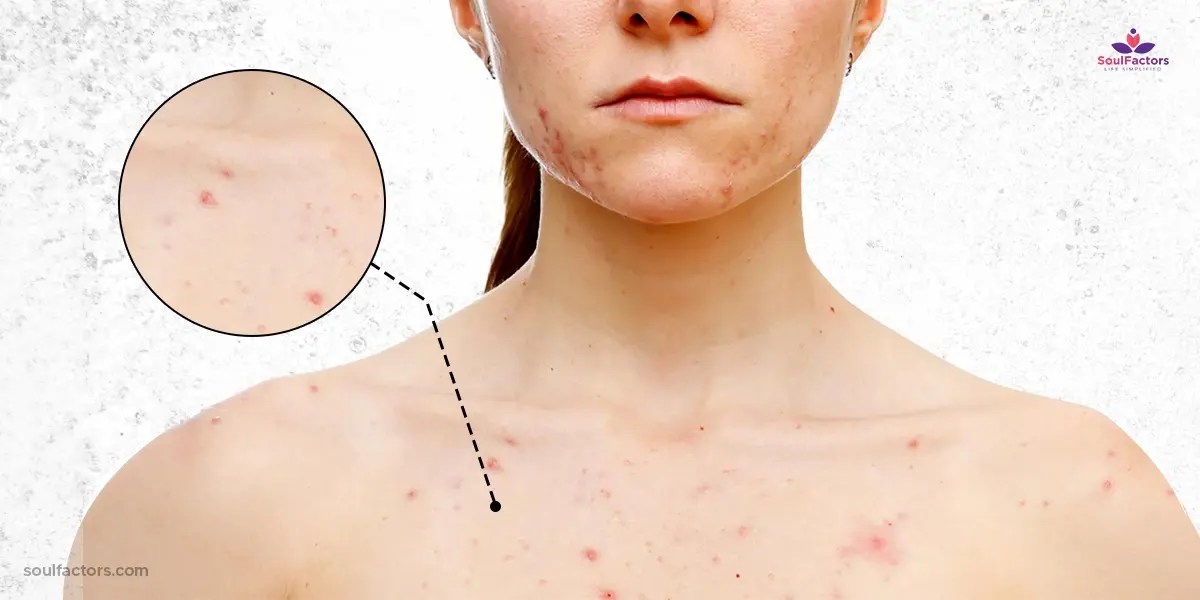 How To Get Rid of Chest Acne Quick And Easy Solutions!