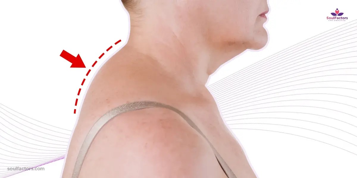 How to Get Rid of Neck Hump Effective Exercises and Solutions!