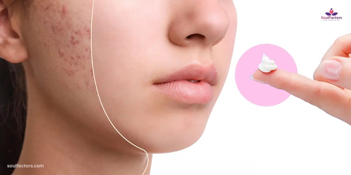 How Do Pimple Patches Work? Are They Making Acne Worse?