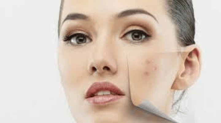 Bagaimana cara menghilangkan bekas jerawat? question & answer
