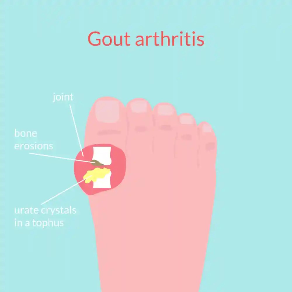 8 Symptoms of Gout Are Quite Easy to Recognise! Soundproof Talk