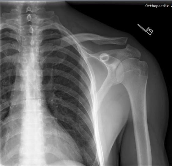 What to expect when you're not expecting, an acromioclavicular (AC