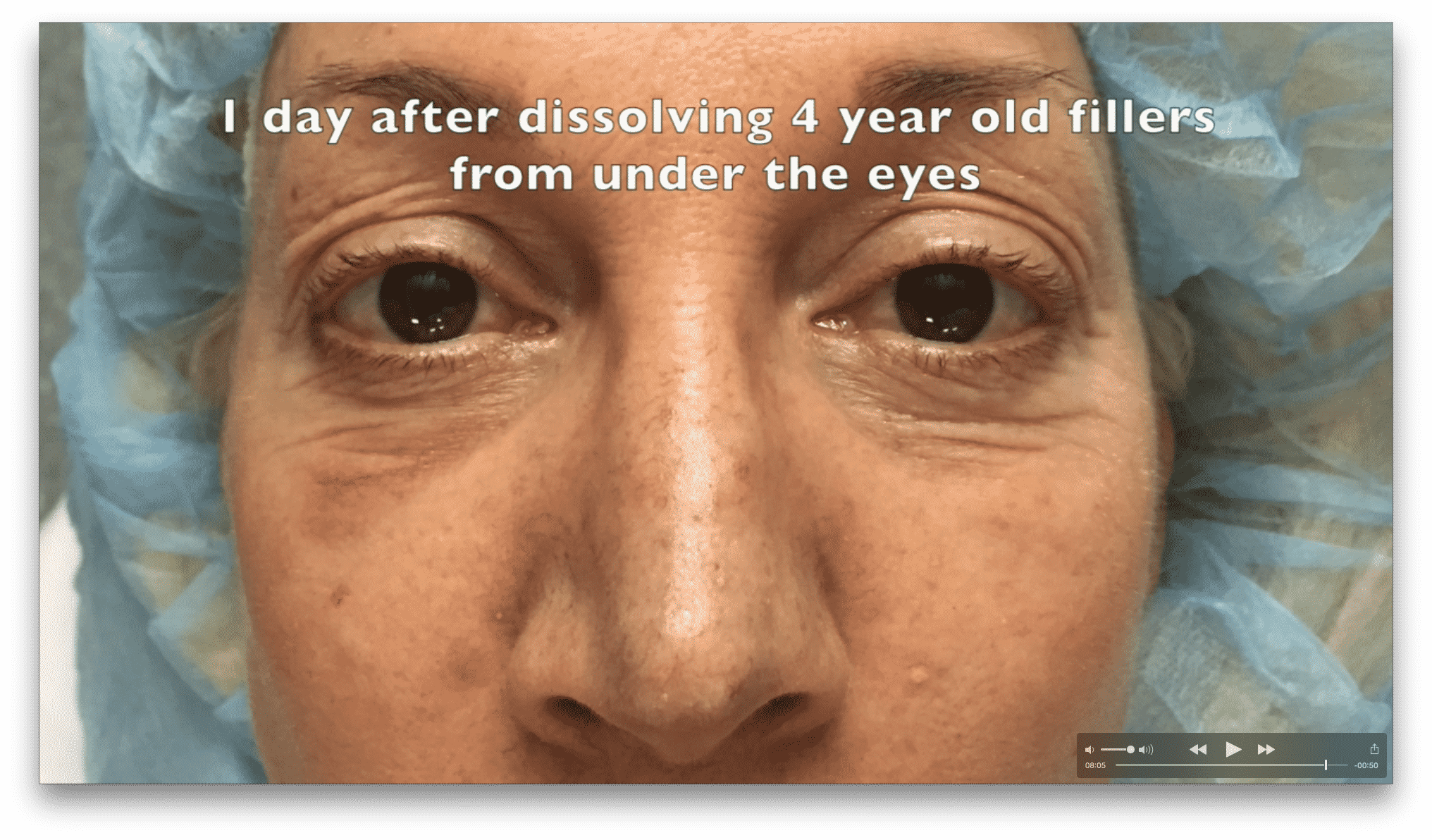 how to dissolve under eye filler at home