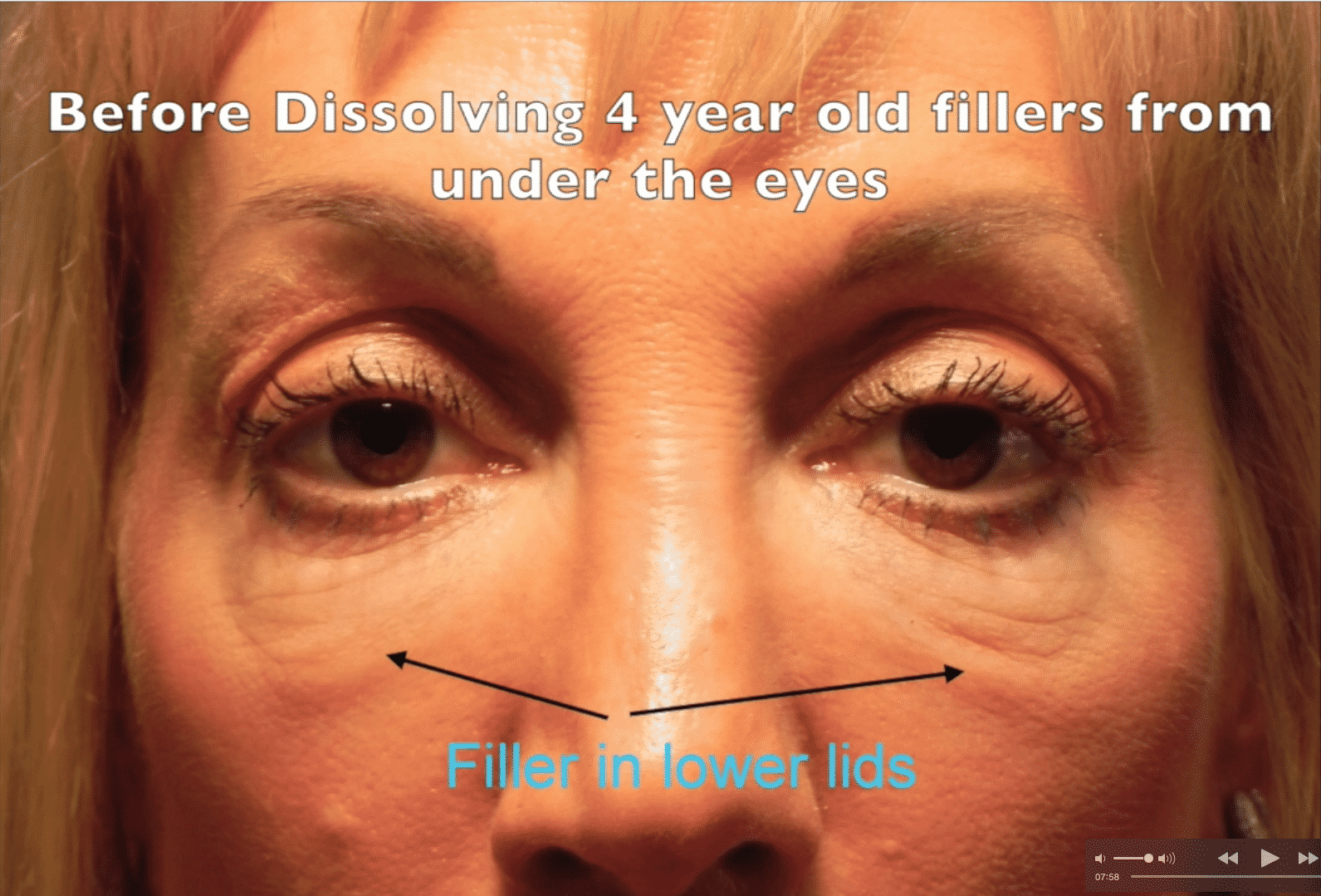 Dissolving Fillers Under the Eyes Dr. Adam Scheiner
