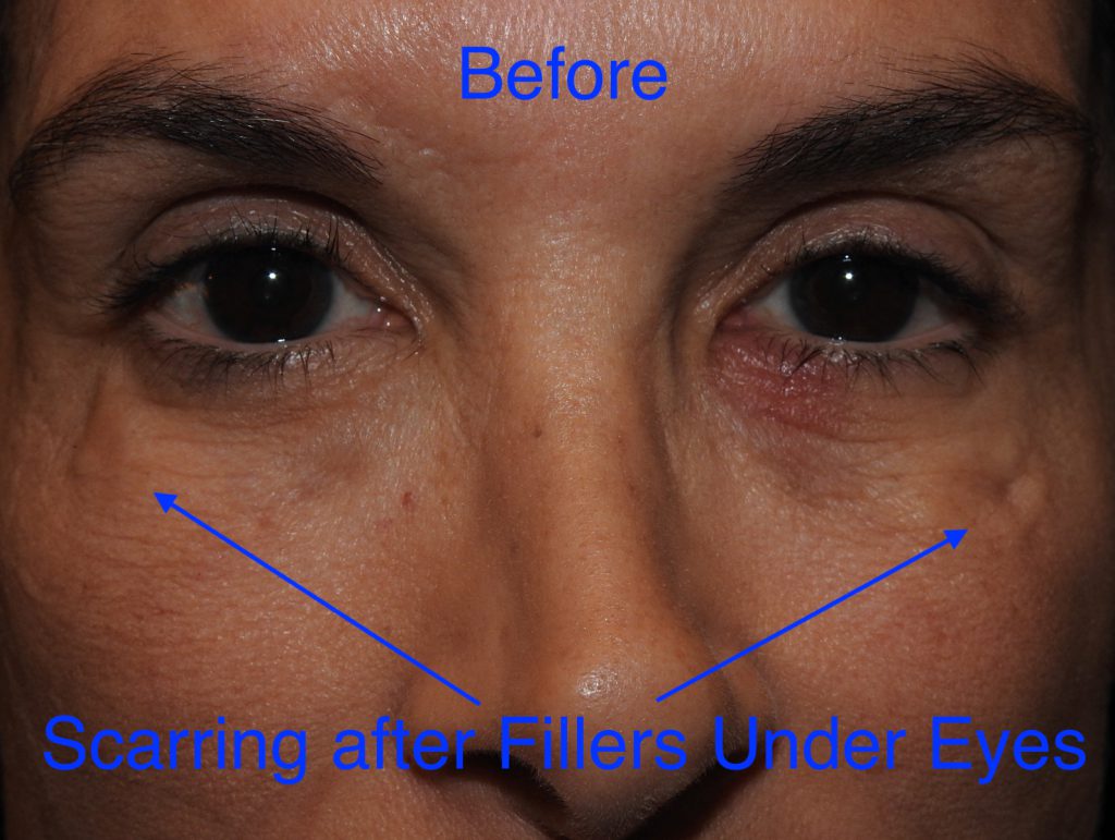 UnderEye Filler Adam Scheiner MD