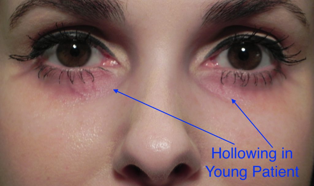 UnderEye Filler Adam Scheiner MD Dr. Adam Scheiner