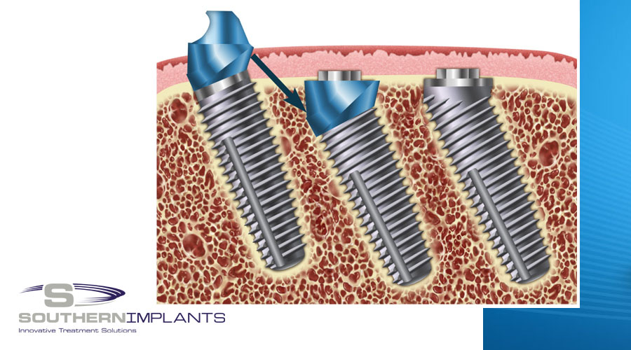 Angled Implant Design to Screwretained Implantsupported
